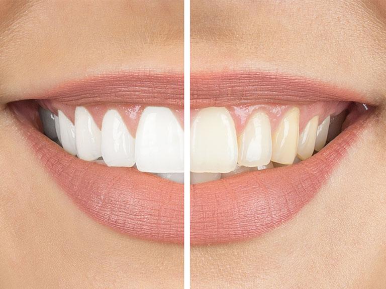 efekt wybielanie zębów