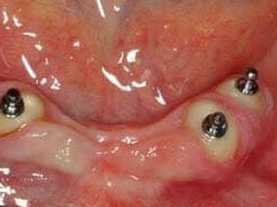 Zabiegi stomatologiczne 5